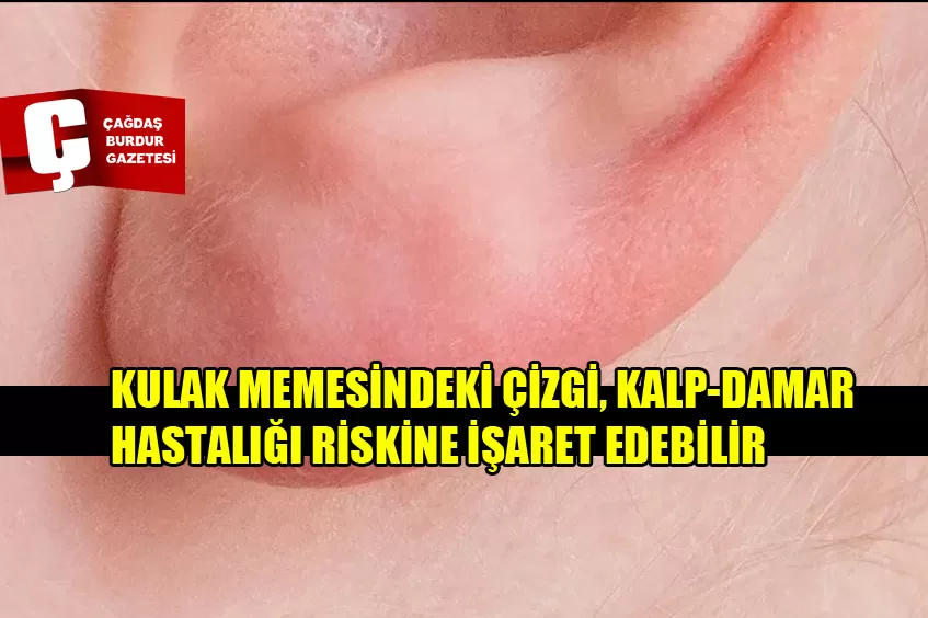 KULAK MEMESİNDEKİ ÇİZGİ, KALP-DAMAR HASTALIĞI RİSKİNE İŞARET EDEBİLİR