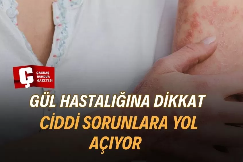 İHMAL EDİLEN GÜL HASTALIĞI KALICI DAMAR SORUNLARINA NEDEN OLUYOR